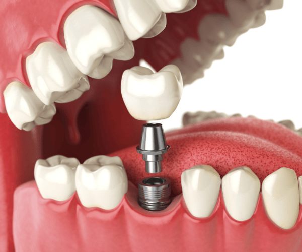 Bring Your Smile Back to Life with Santes Oral and Dental Health Clinic